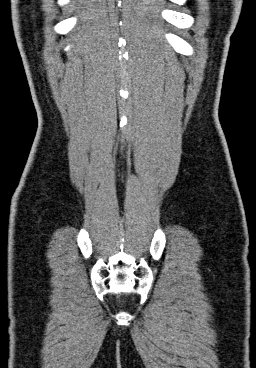 Adhesional small bowel obstruction (Radiopaedia 58900-66131 Coronal C+ portal venous phase 219).jpg