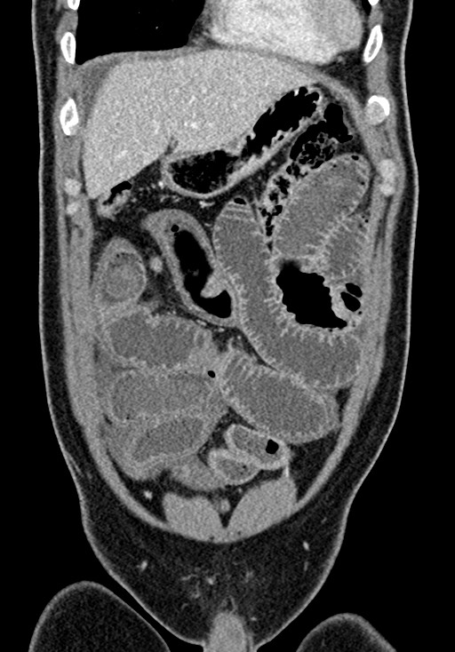 Adhesional small bowel obstruction (Radiopaedia 58900-66131 Coronal C+ portal venous phase 87).jpg