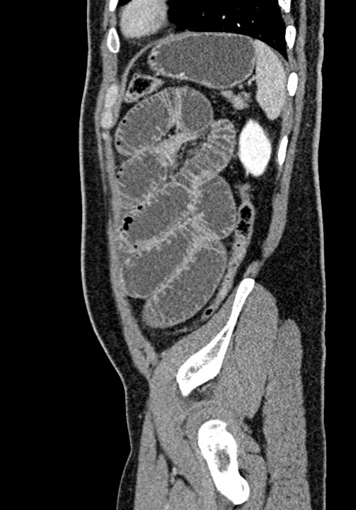 Adhesional small bowel obstruction (Radiopaedia 58900-66131 Sagittal C+ portal venous phase 205).jpg