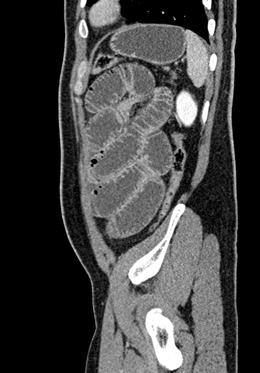 Adhesional small bowel obstruction (Radiopaedia 58900-66131 Sagittal C+ portal venous phase 206).jpg