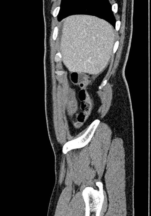 Adhesional small bowel obstruction (Radiopaedia 58900-66131 Sagittal C+ portal venous phase 32).jpg