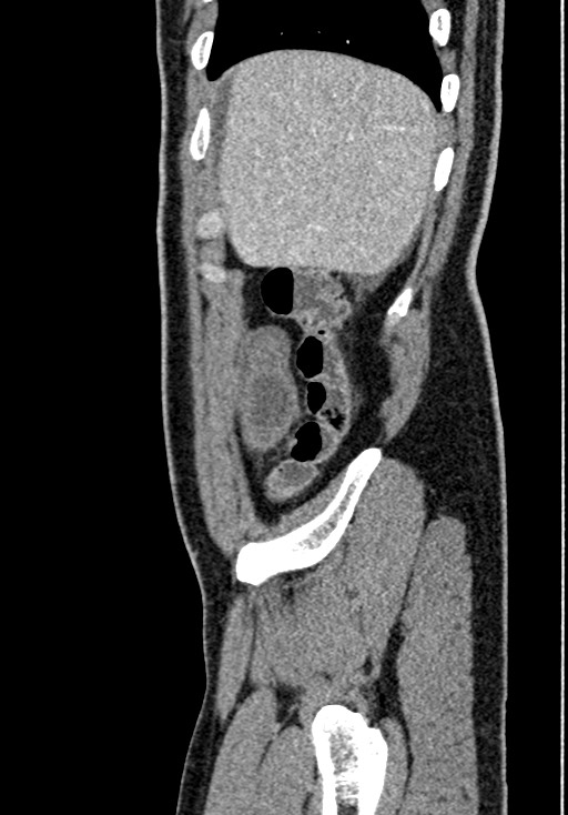 Adhesional small bowel obstruction (Radiopaedia 58900-66131 Sagittal C+ portal venous phase 35).jpg
