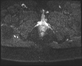 Adnexal multilocular cyst (O-RADS US 3- O-RADS MRI 3) (Radiopaedia 87426-103754 Axial DWI 27).jpg