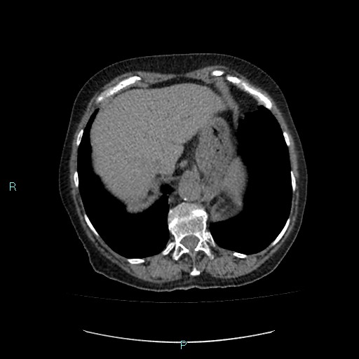 File:Adrenal collision tumor (ACT) (Radiopaedia 48462-53379 Axial non-contrast 9).jpg