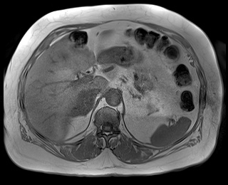 File:Adrenal cortical carcinoma (Radiopaedia 64017-72770 Axial T1 in-phase 22).jpg
