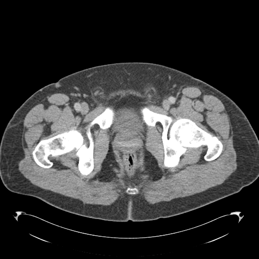 Adrenal cyst (Radiopaedia 45625-49776 Axial C+ portal venous phase 97).png