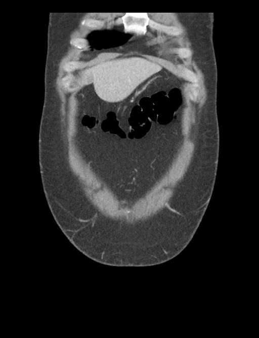 Adrenal cyst (Radiopaedia 45625-49777 Coronal C+ portal venous phase 12).png