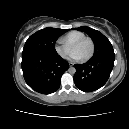 Adrenal cyst (Radiopaedia 64869-73813 Axial C+ portal venous phase 3).jpg