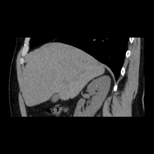 File:Adrenal gland trauma (Radiopaedia 81351-95079 Sagittal non-contrast 32).jpg
