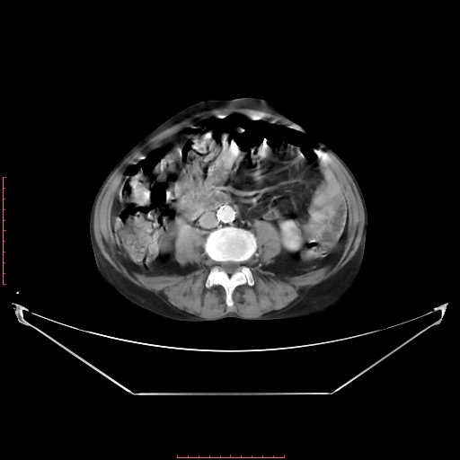 Adrenal hemangioma (Radiopaedia 68923-78668 Axial C+ portal venous phase 42).jpg