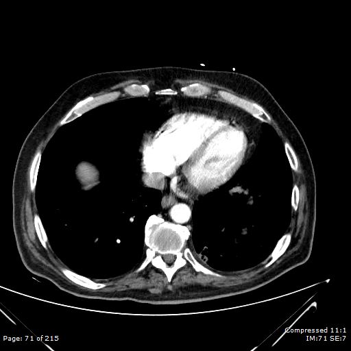 Adrenal metastasis (Radiopaedia 78425-91079 Axial C+ arterial phase 1).jpg