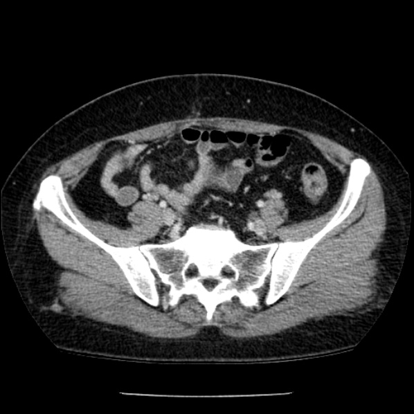 Adrenal myelolipoma (Radiopaedia 43401-46759 Axial C+ portal venous phase 67).jpg