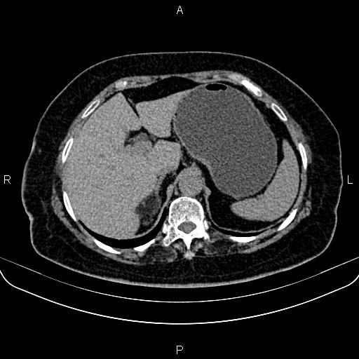 Adrenal myelolipoma (Radiopaedia 82742-96986 Axial non-contrast 32).jpg