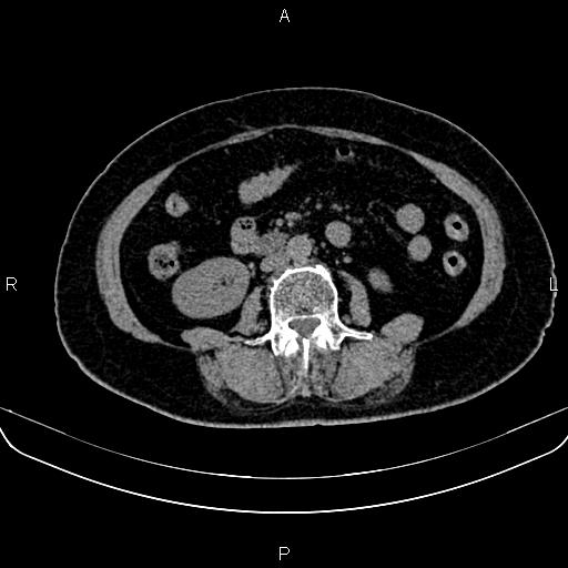 File:Adrenal myelolipoma (Radiopaedia 82742-96986 Axial non-contrast 86).jpg