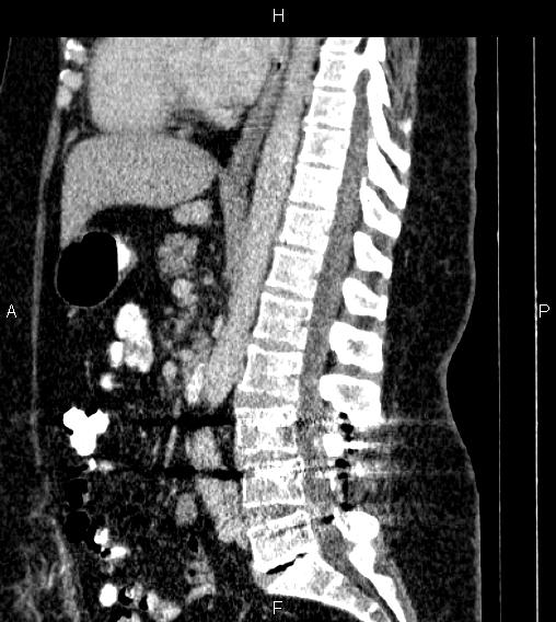 File:Adrenal myelolipoma (Radiopaedia 84319-99617 Sagittal renal cortical phase 49).jpg