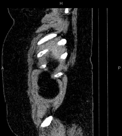 Adrenal myelolipoma (Radiopaedia 84319-99617 Sagittal renal cortical phase 93).jpg