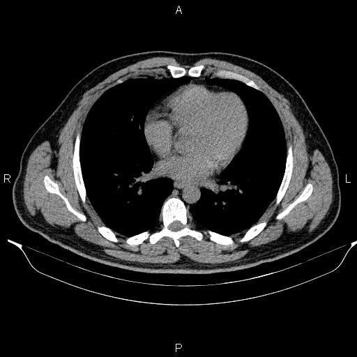 Adrenal myelolipoma (Radiopaedia 84321-99619 Axial non-contrast 3).jpg