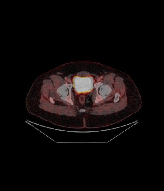 Adrenocortical carcinoma (Radiopaedia 80134-93440 ِAxial 248).jpg