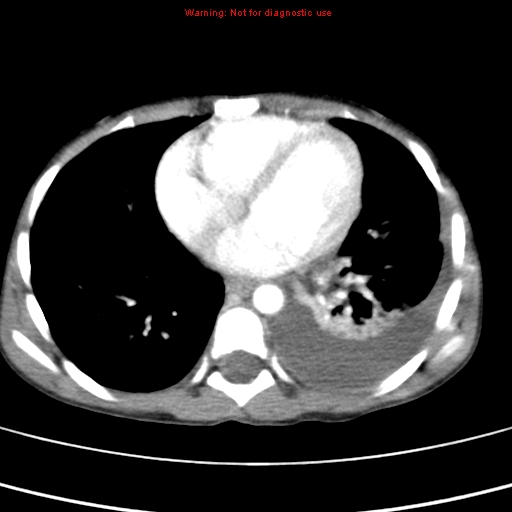 File:Adrenocortical carcinoma (Radiopaedia 9449-10131 Axial C+ portal venous phase 1).jpg