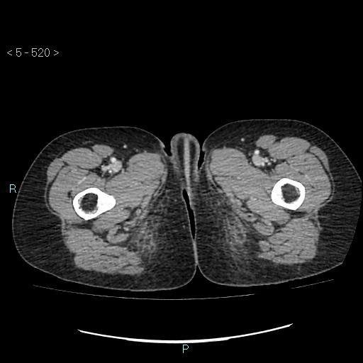 File:Adult transient intestinal intussusception (Radiopaedia 34853-36310 Axial C+ portal venous phase 144).jpg