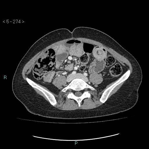Adult transient intestinal intussusception (Radiopaedia 34853-36310 Axial C+ portal venous phase 61).jpg