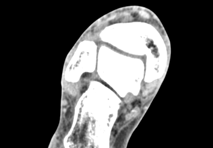 Advanced osteomyelitis due to open metatarsal fracture (Radiopaedia 83891-99095 Axial non-contrast 4).jpg