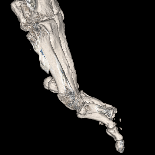 File:Advanced osteomyelitis due to open metatarsal fracture (Radiopaedia 83891-99095 VRT 23).jpg