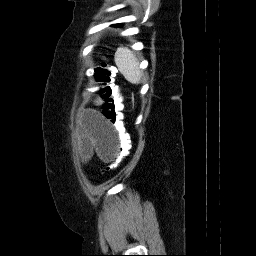 File:Afferent loop syndrome - secondary to incarcerated trocar site hernia (Radiopaedia 82959-97305 Sagittal C+ portal venous phase 16).jpg