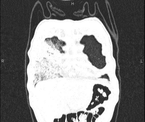 Air bronchogram in pneumonia (Radiopaedia 85719-101512 Coronal lung window 6).jpg