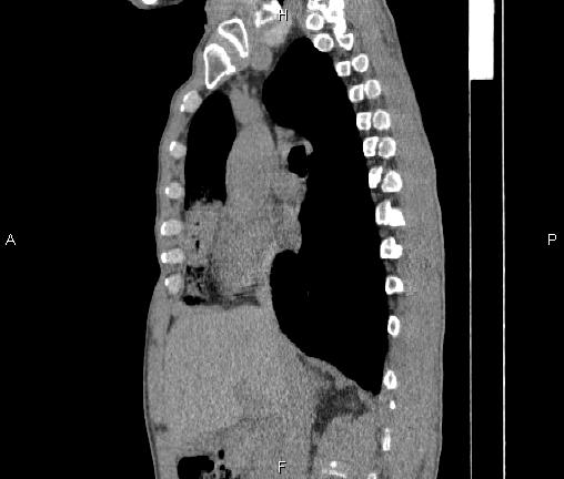 File:Air bronchogram in pneumonia (Radiopaedia 85719-101512 F 40).jpg
