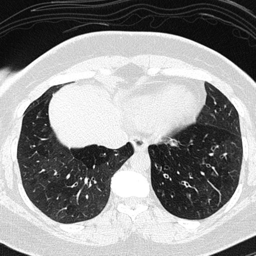 File:Air trapping in small airway disease (Radiopaedia 61685-69694 Axial lung window 141).jpg