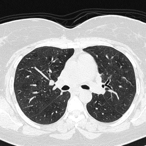 Air trapping in small airway disease (Radiopaedia 61685-69694 Axial lung window 72).jpg