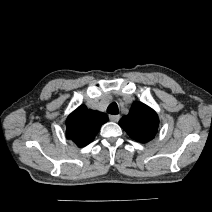 Airway foreign body in adult (Radiopaedia 85907-101779 Axial liver window 3).jpg