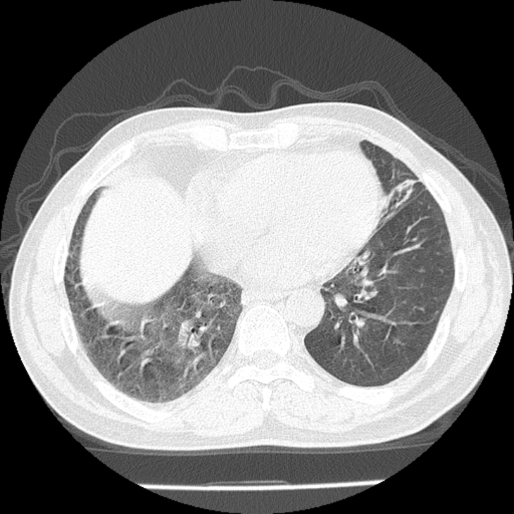 Airway foreign body in adult (Radiopaedia 85907-101779 Axial lung window 128).jpg