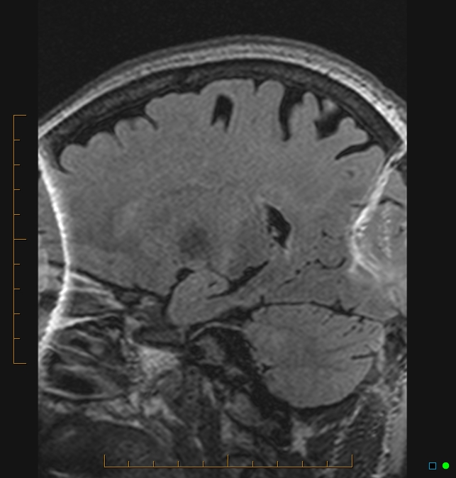 Aliasing artifact causing a spurious cerebellar lesion (Radiopaedia 48783-53810 Sagittal FLAIR 75).jpg