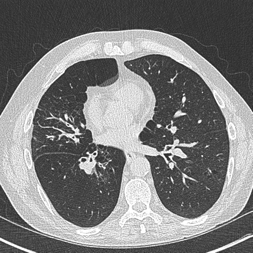 Allergic bronchopulmonary aspergillosis (Radiopaedia 44760-48571 Axial lung window 38).png