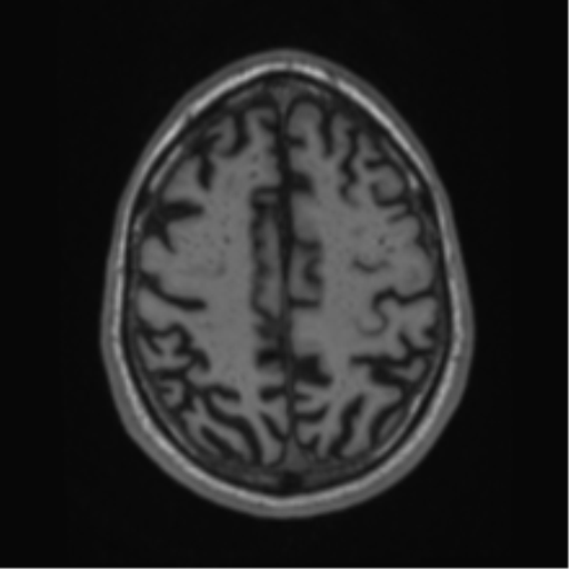 Alzheimer's disease- with Gerstmann syndrome and dressing apraxia (Radiopaedia 54882-61150 Axial T1 58).png