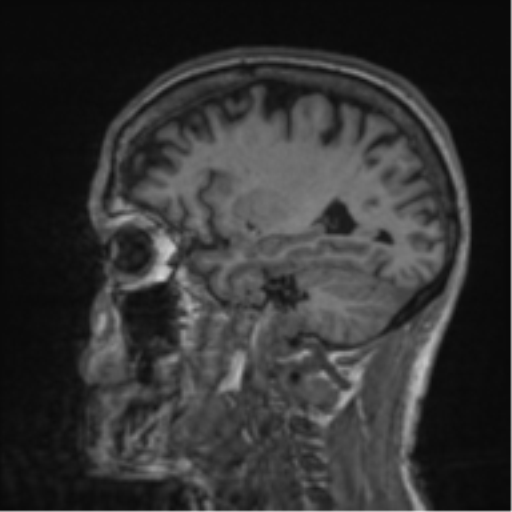 File:Alzheimer's disease- with apraxia (Radiopaedia 54763-61011 Sagittal T1 22).png