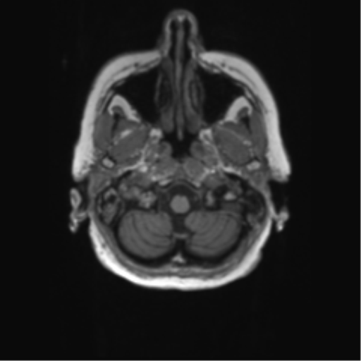 File:Alzheimer's disease (Radiopaedia 42658-45802 Axial T1 135).png