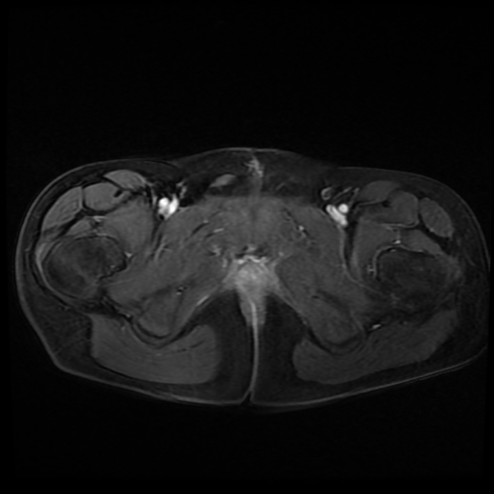 Ambiguous genitalia (Radiopaedia 69686-79643 Axial T1 C+ fat sat 47).jpg