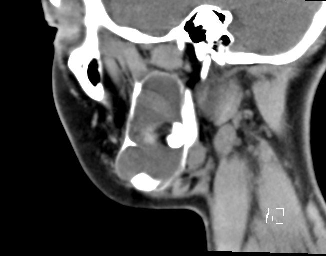 File:Ameloblastoma (Radiopaedia 26645-26793 Sagittal C+ delayed 7).jpg