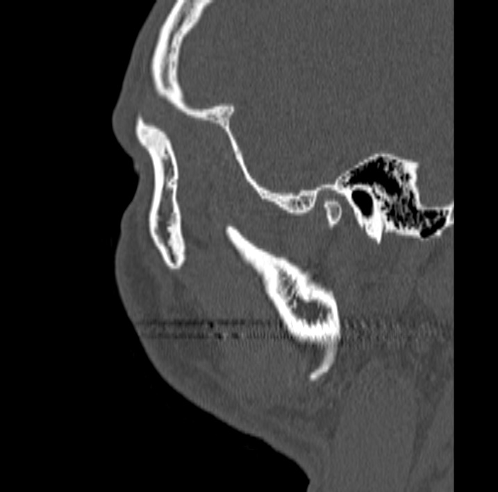 Ameloblastoma (Radiopaedia 77750-89997 Sagittal bone window 108).jpg
