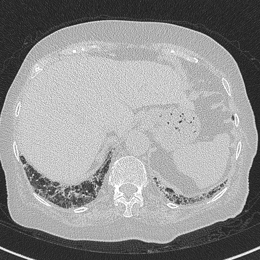 Amiodarone-induced pulmonary fibrosis (Radiopaedia 82355-96460 Axial lung window 61).jpg