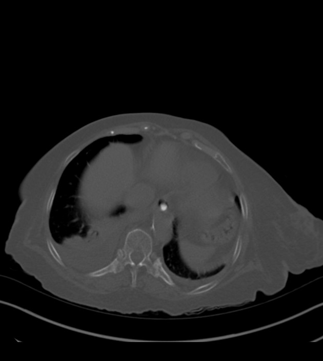 Amiodarone deposition in the liver (Radiopaedia 77587-89780 Axial bone window 66).jpg