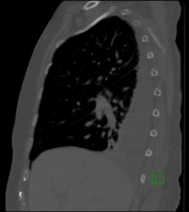 Amiodarone deposition in the liver (Radiopaedia 77587-89780 Sagittal bone window 68).jpg