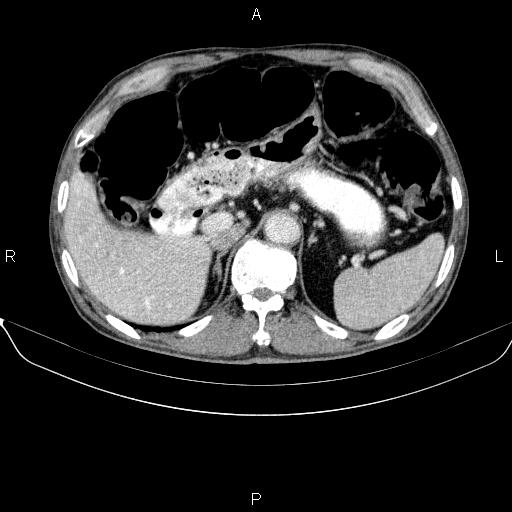 Ampullary adenocarcinoma (Radiopaedia 86093-102032 A 17).jpg