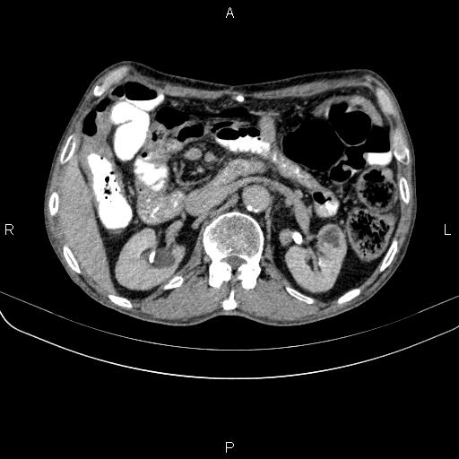 Ampullary adenocarcinoma (Radiopaedia 86093-102033 Axial C+ delayed 44).jpg