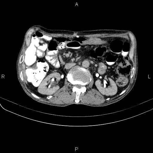 Ampullary adenocarcinoma (Radiopaedia 86093-102033 Axial C+ delayed 52).jpg