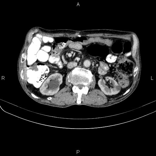 File:Ampullary adenocarcinoma (Radiopaedia 86093-102033 B 67).jpg
