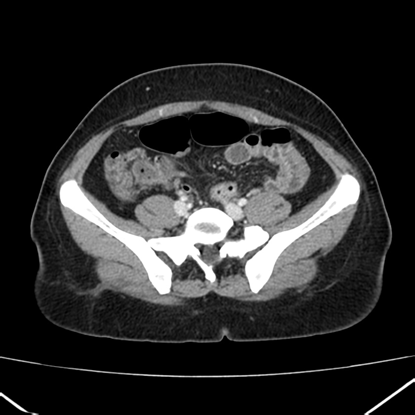 Ampullary tumor (Radiopaedia 22787-22816 C 49).jpg